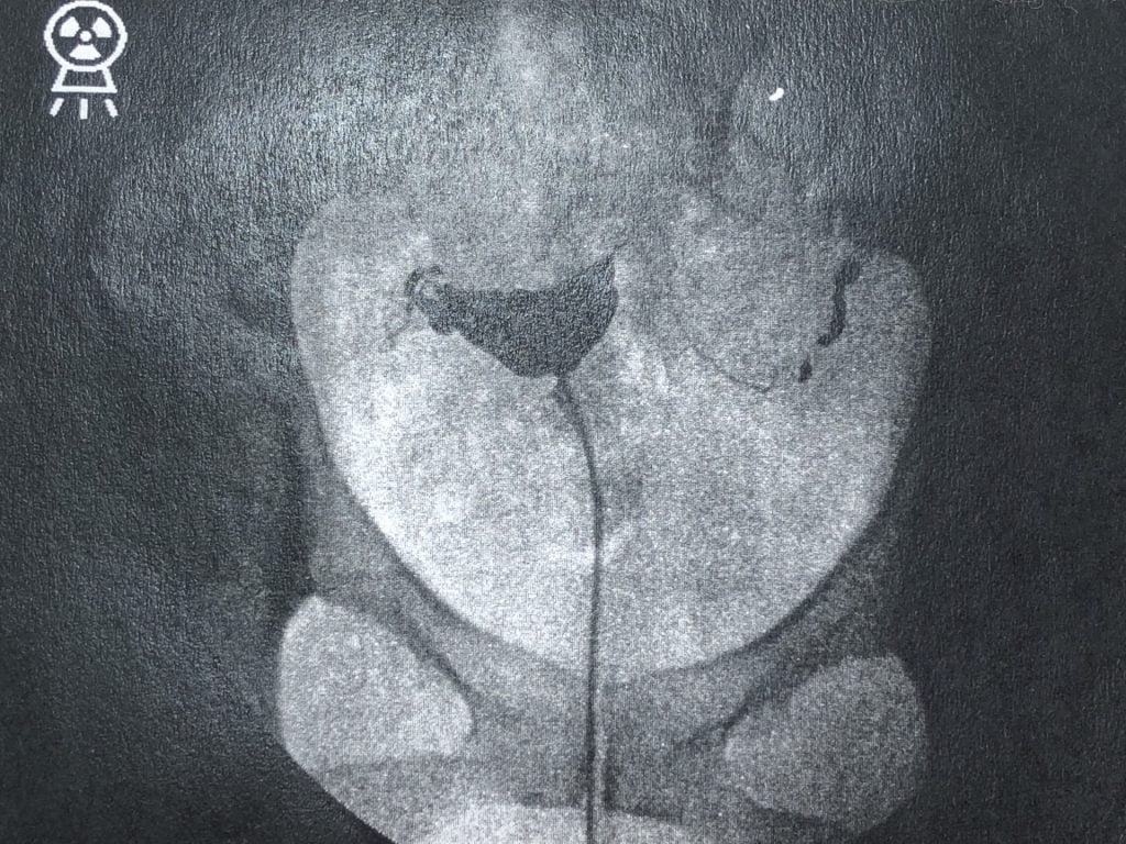 子宮卵管造影検査とは?